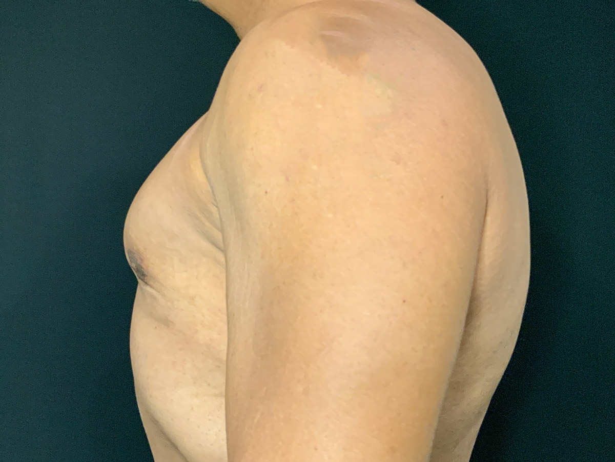 Case--3079 | After Gynecomastia 2