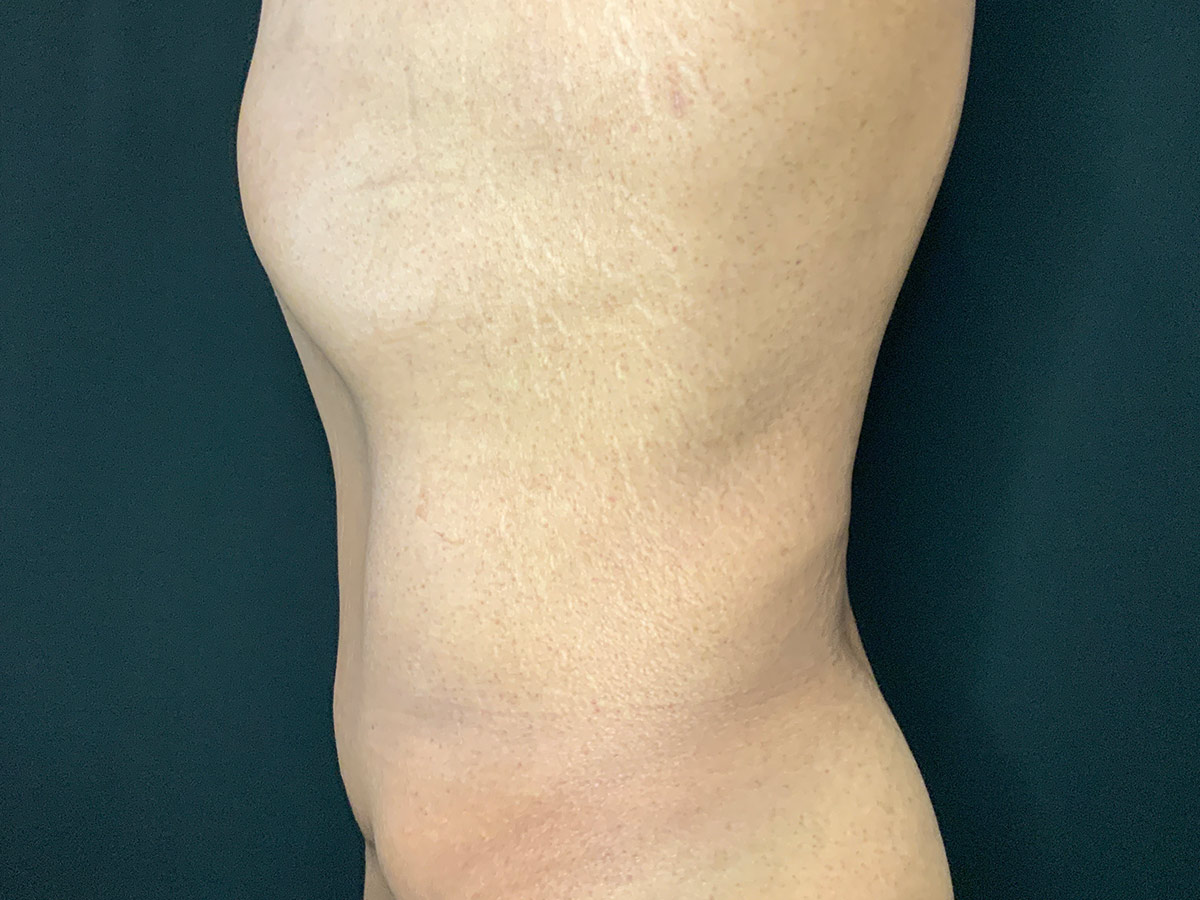 Case--4828 | After Male Tummy Tuck 2