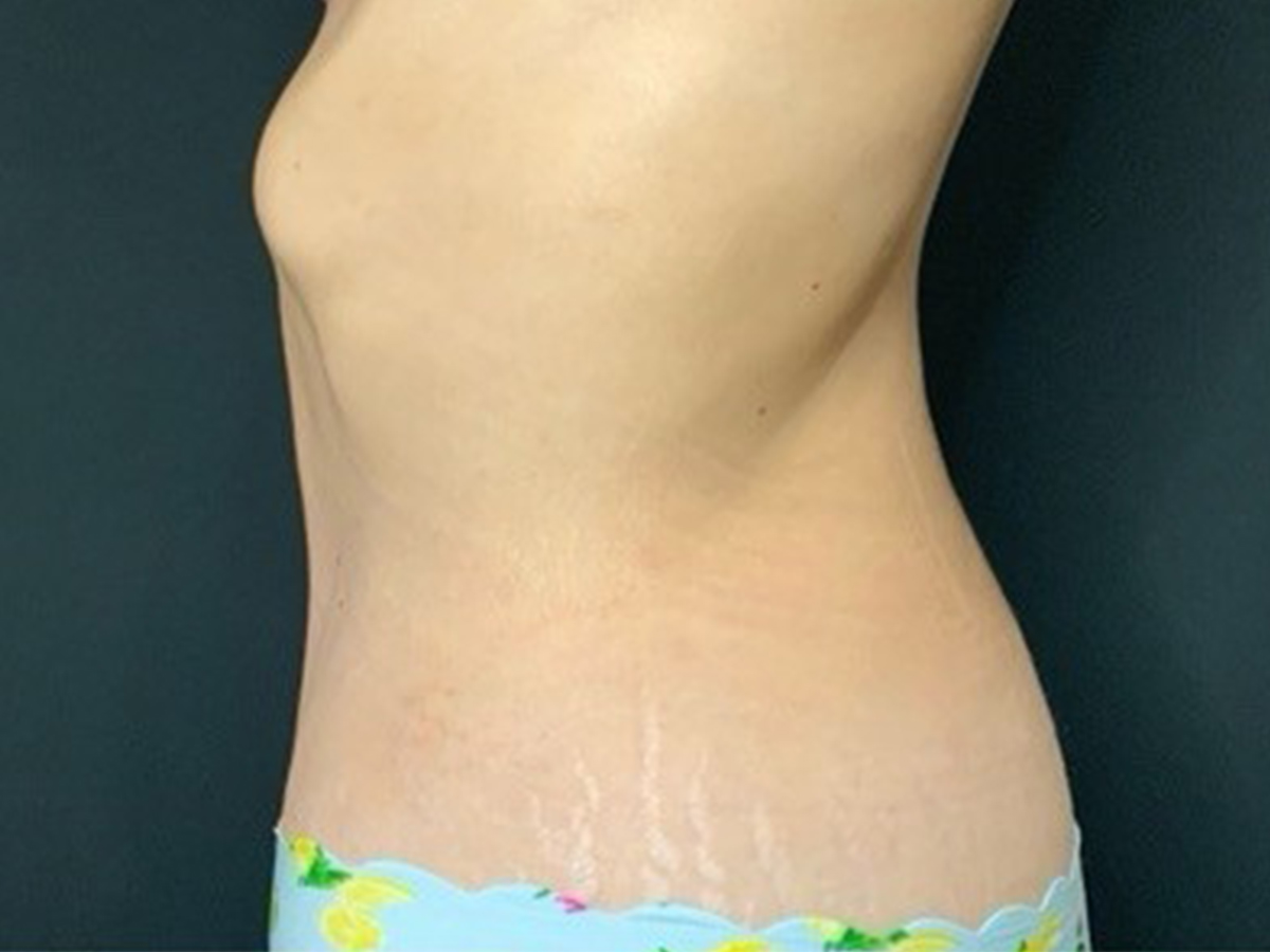 Case--7011 | After Tummy Tuck 2