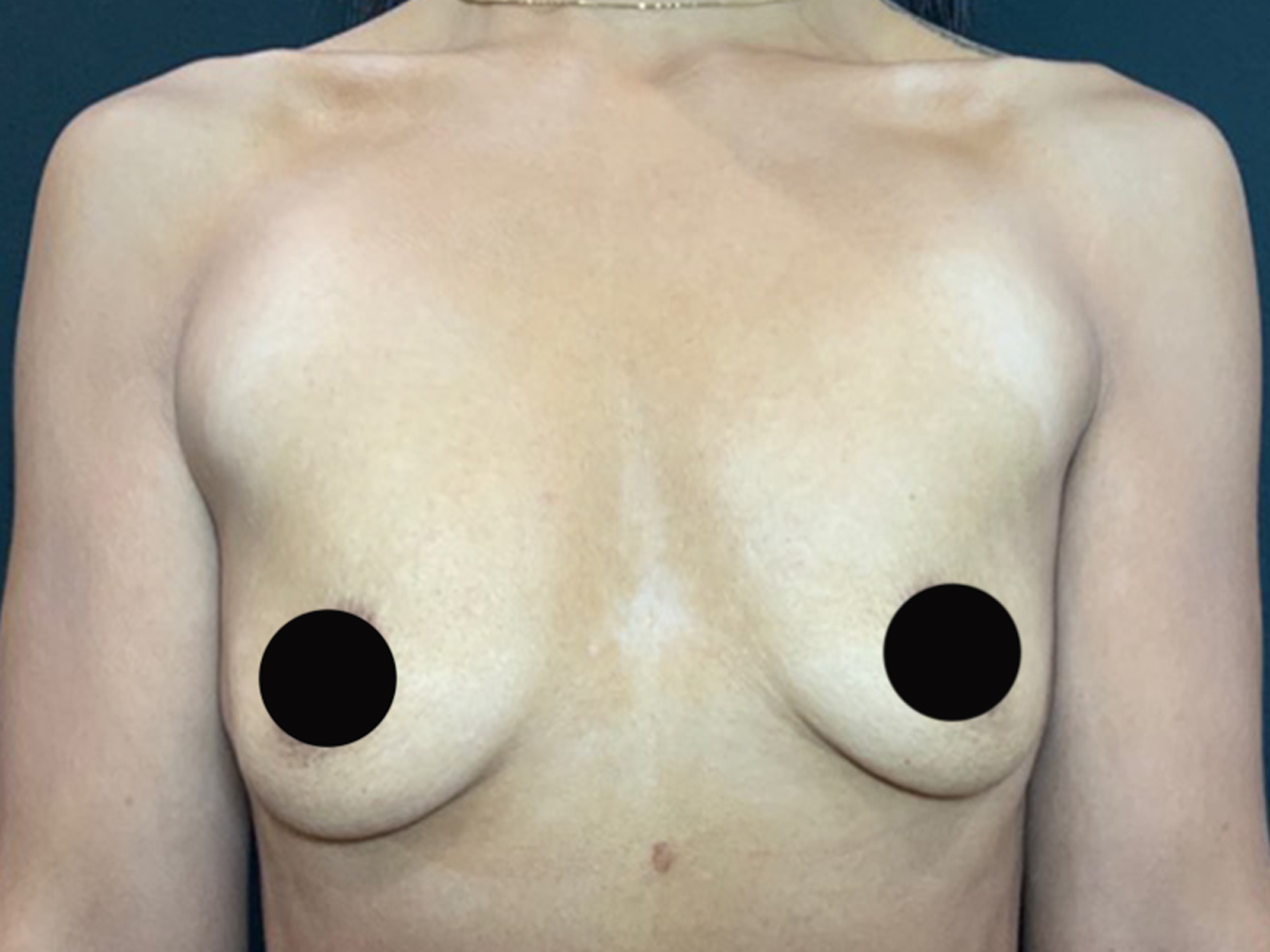 Case--2758 | Before Breast Augmentation