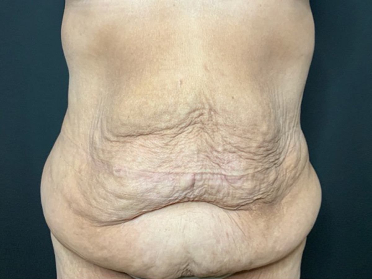 Case--2683 | Before Body