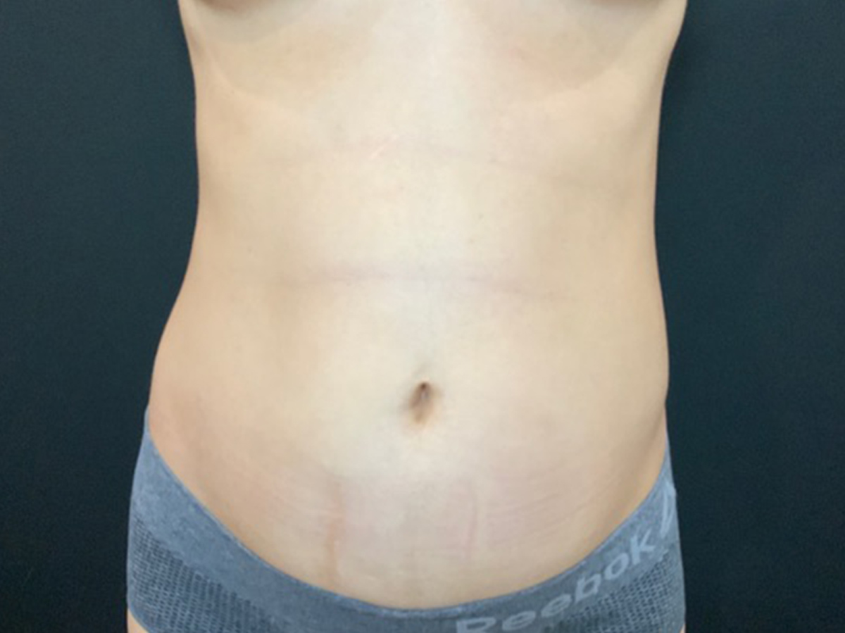 Case--1510 | Before Body