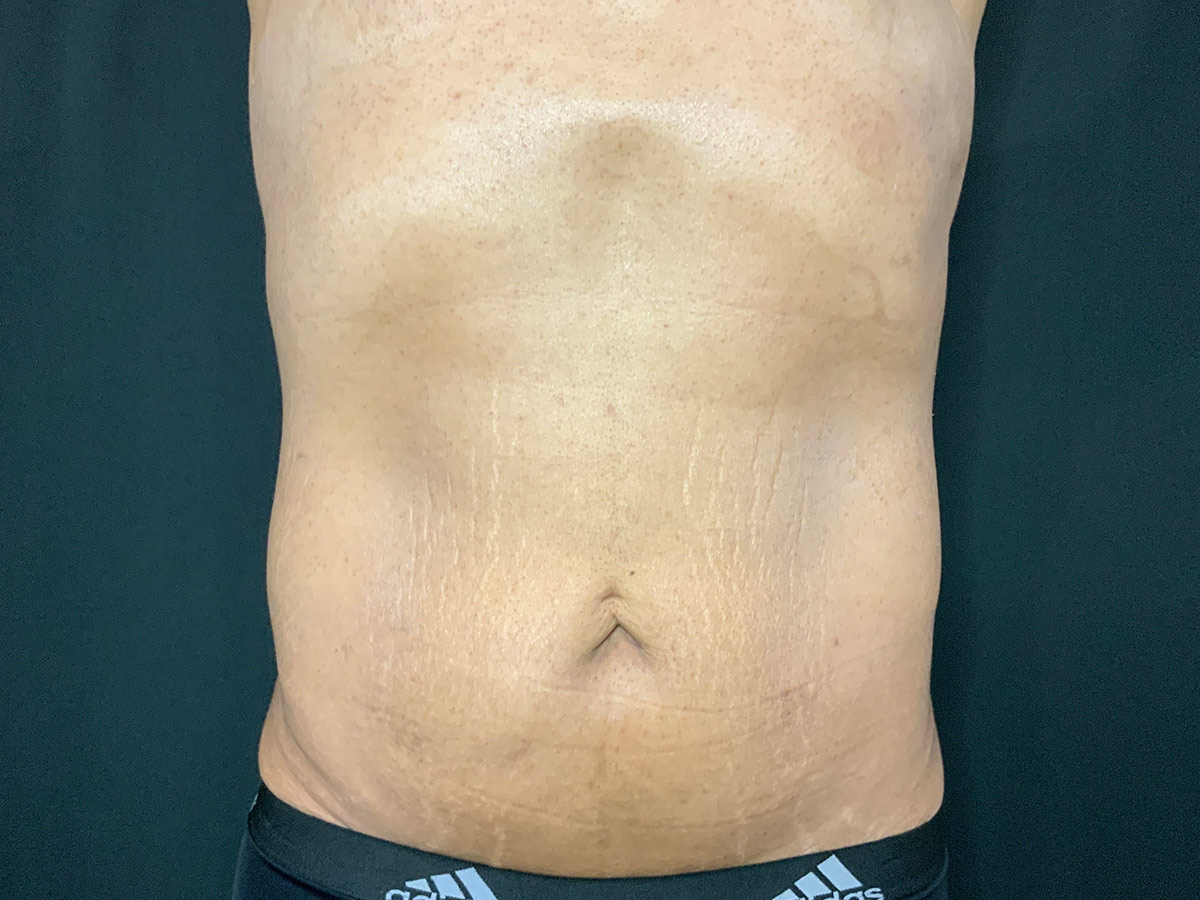 Case--4828 | Before Tummy Tuck