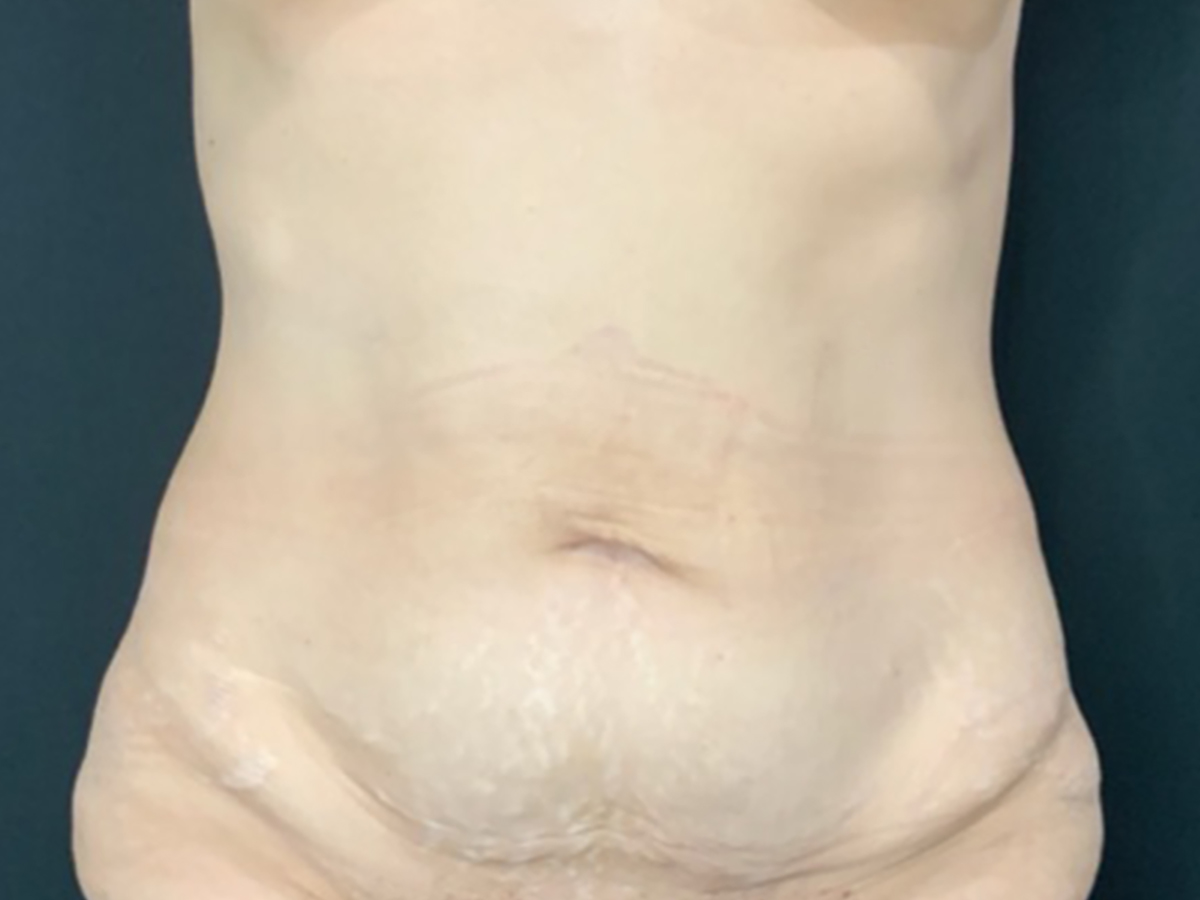 Case--7011 | Before Tummy Tuck