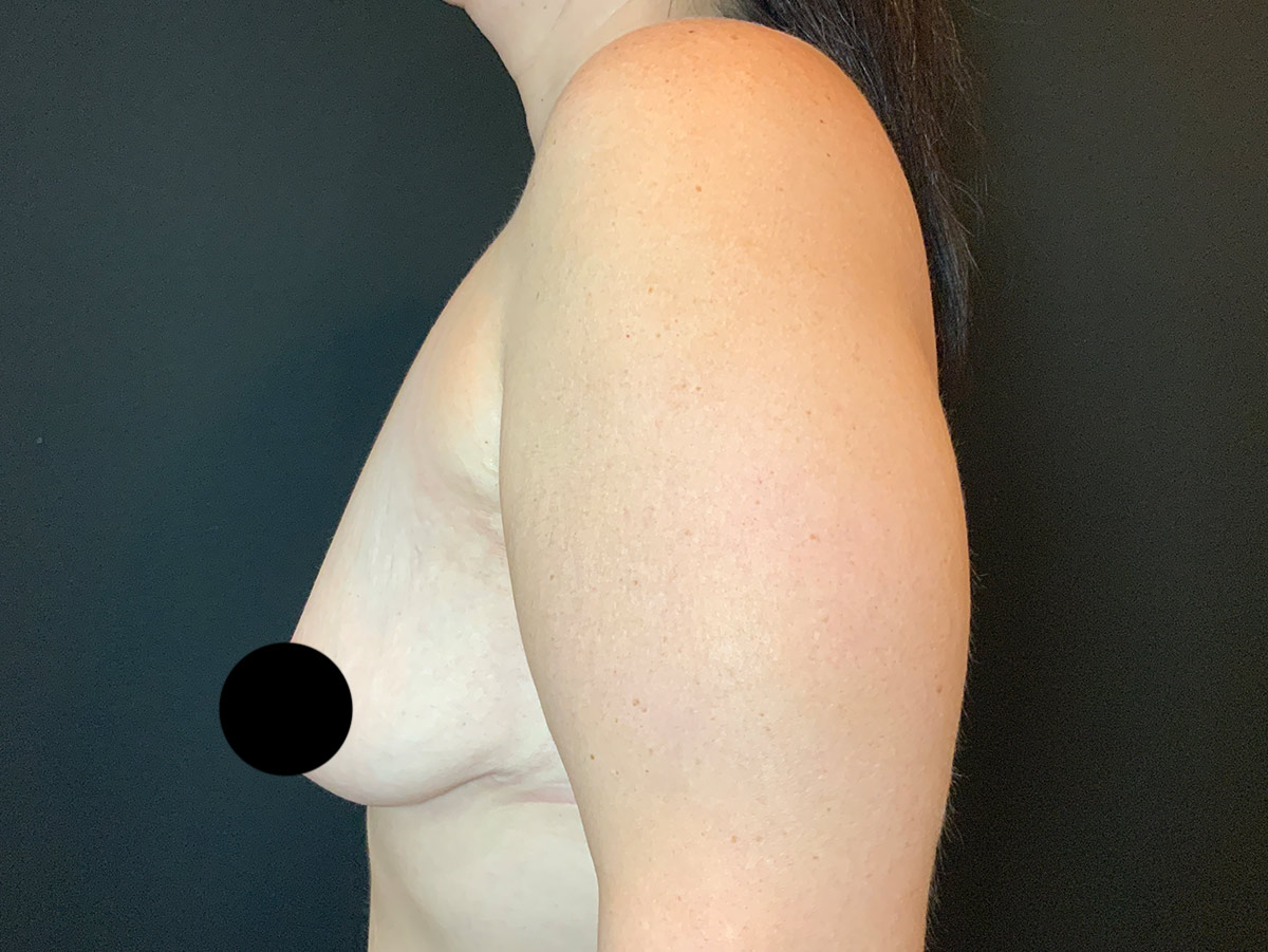 Case--7927 | Before Breast Augmentation + Lift 2