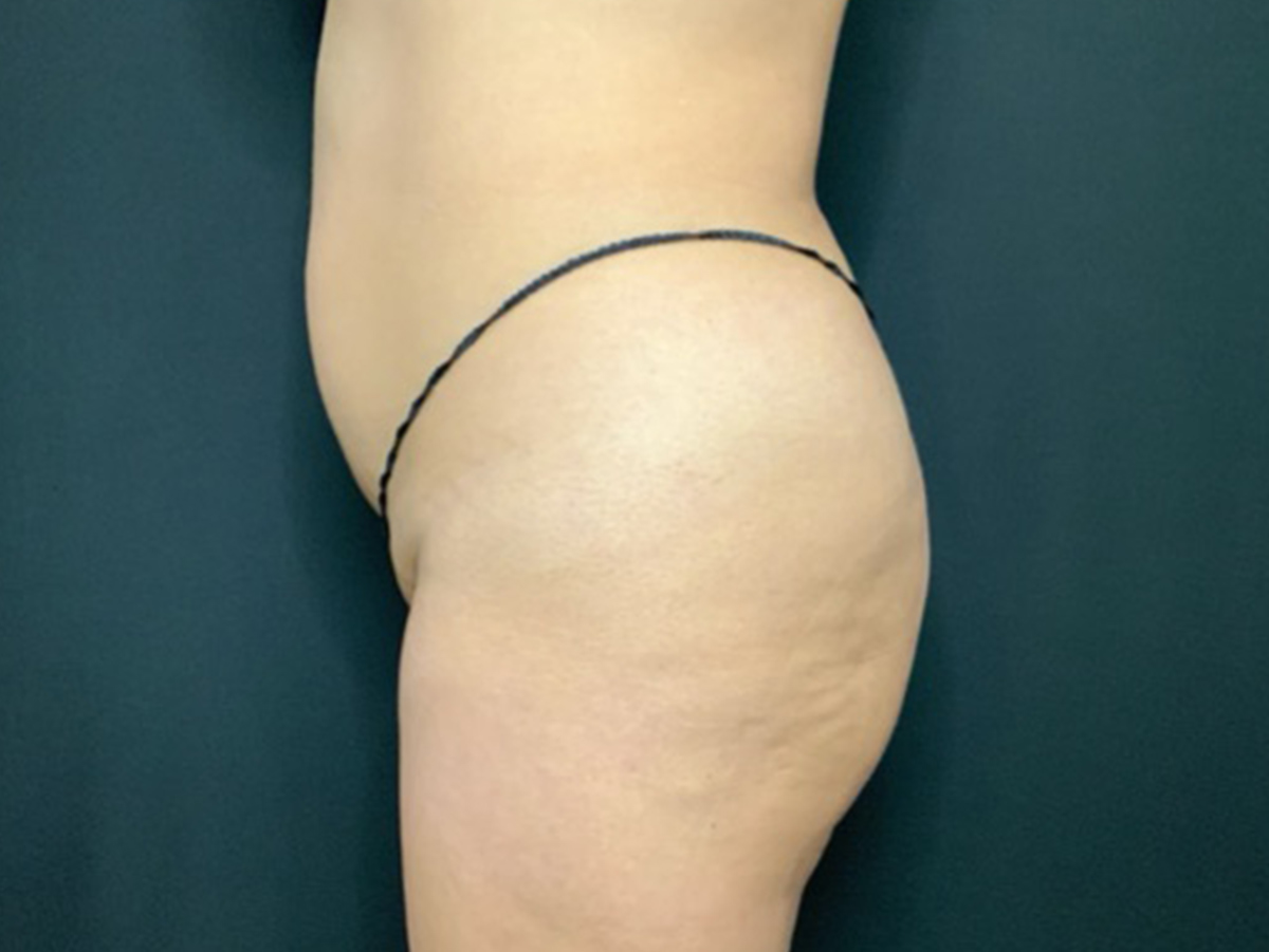 Case--3818 | Before Brazilian Butt Lift 2