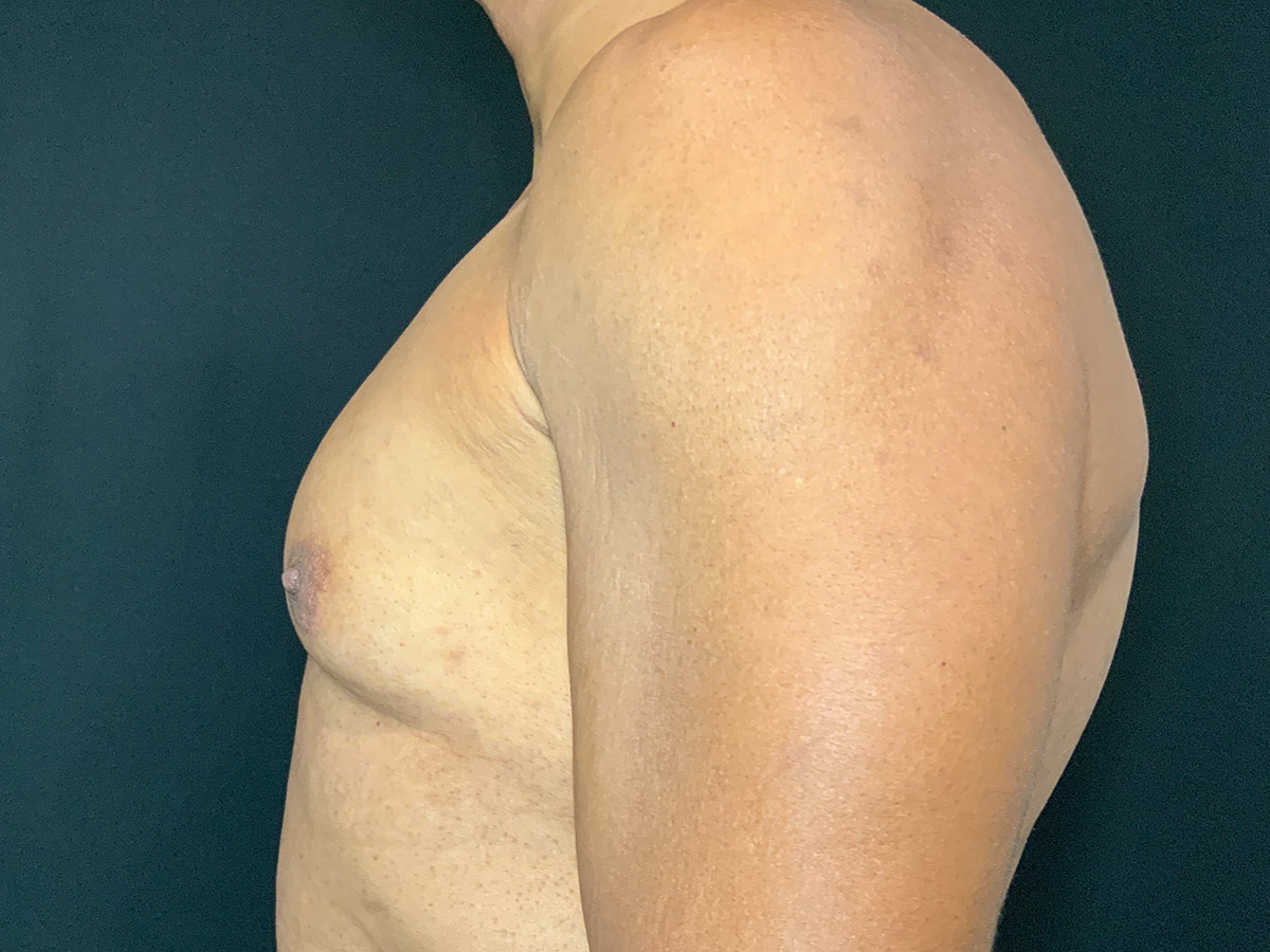 Case--3079 | Before Gynecomastia 2