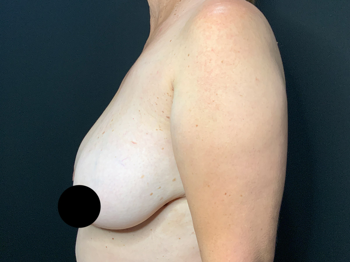 Case--1878 | Before Breast Lift 2