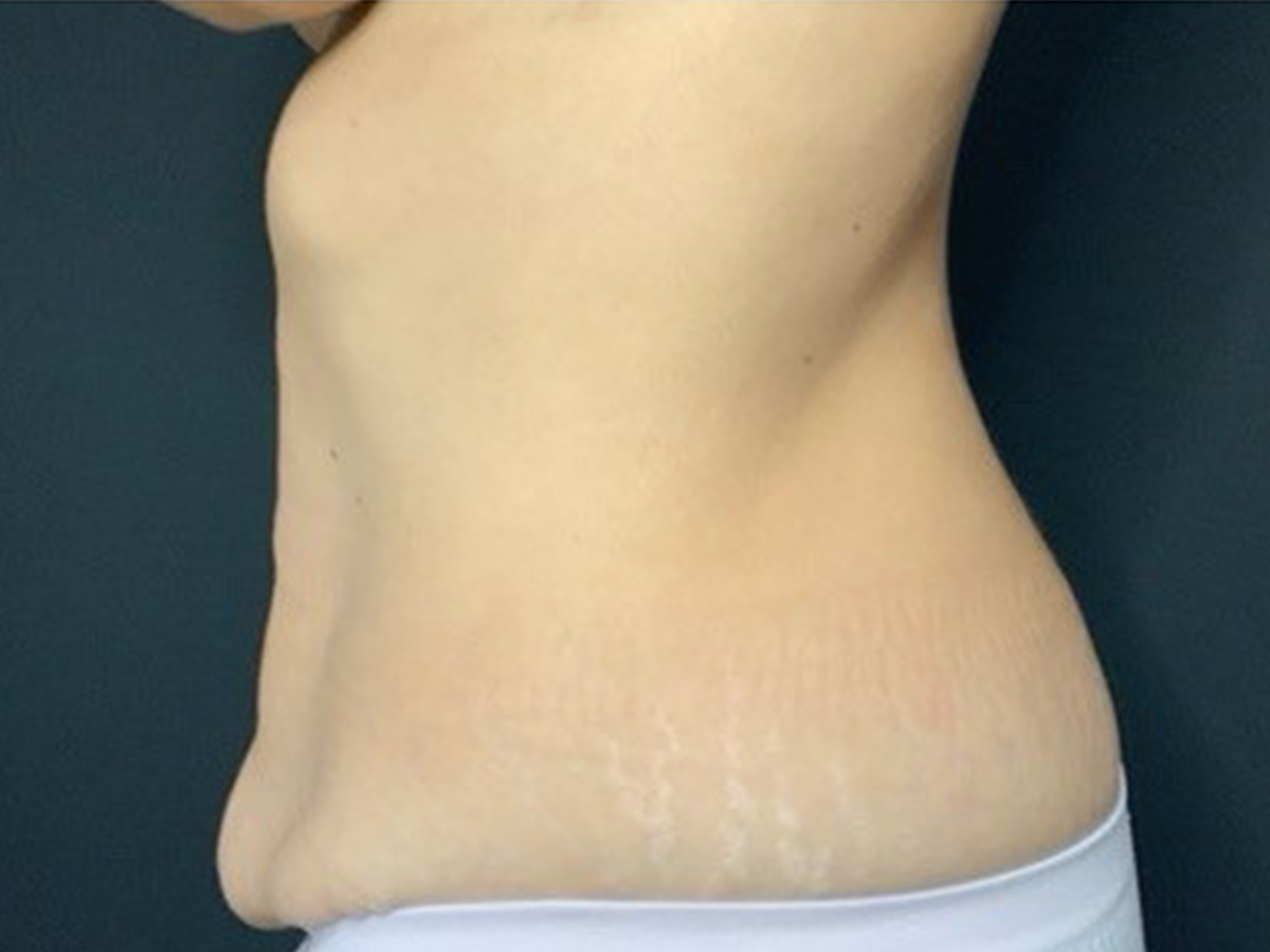 Case--7011 | Before Tummy Tuck 2