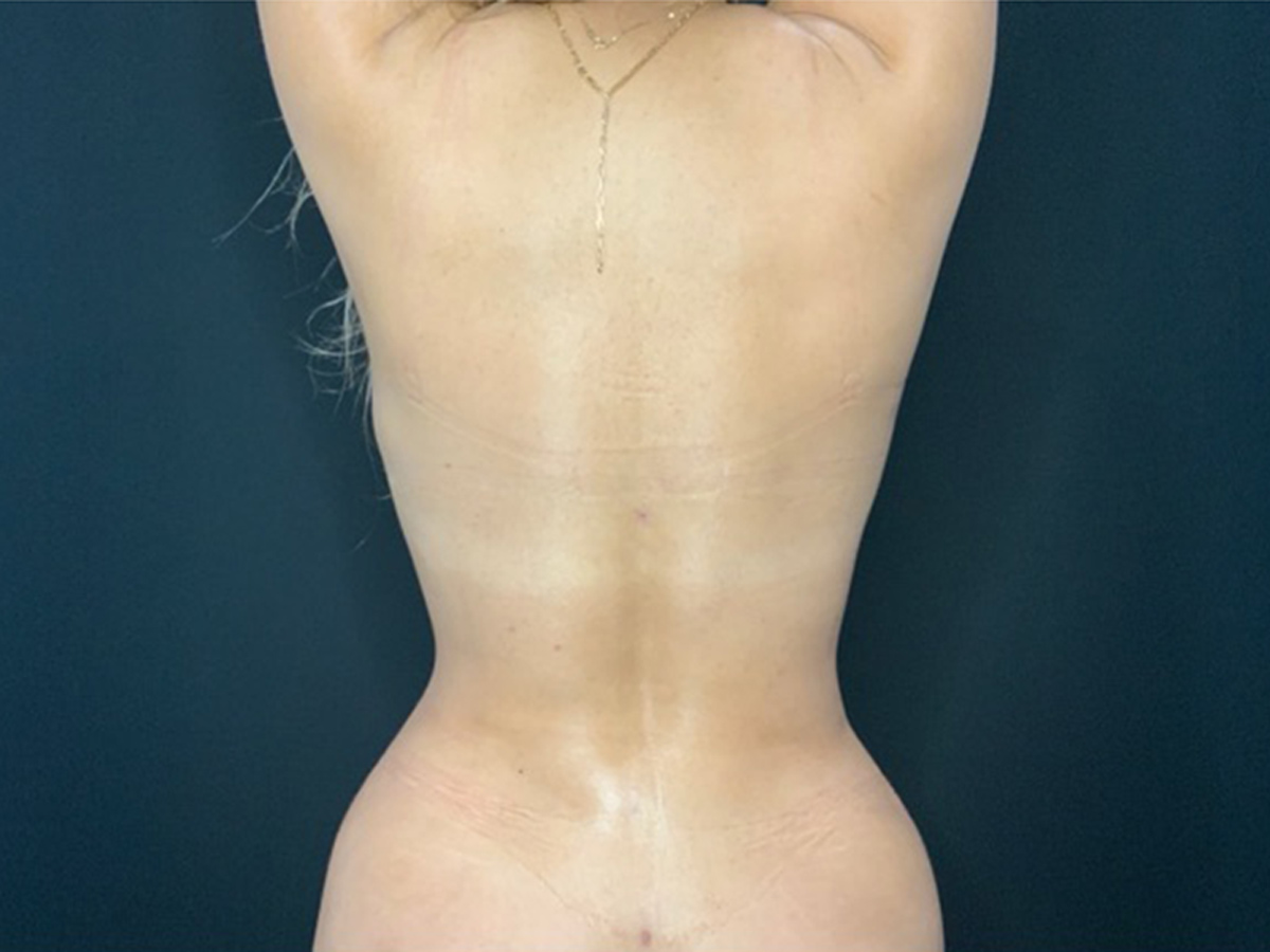 Case--8148 | After Liposuction 2