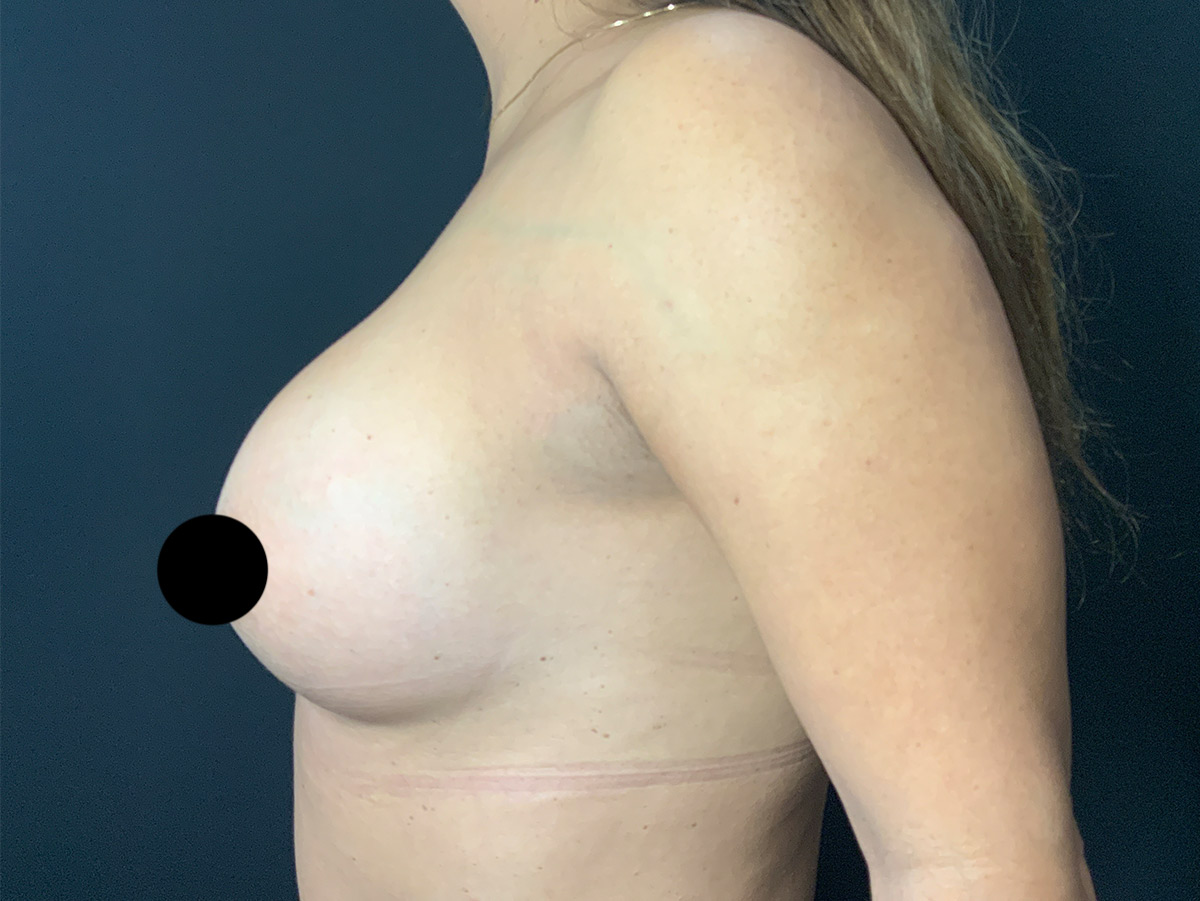 Case--6917 | After Breast Augmentation 2