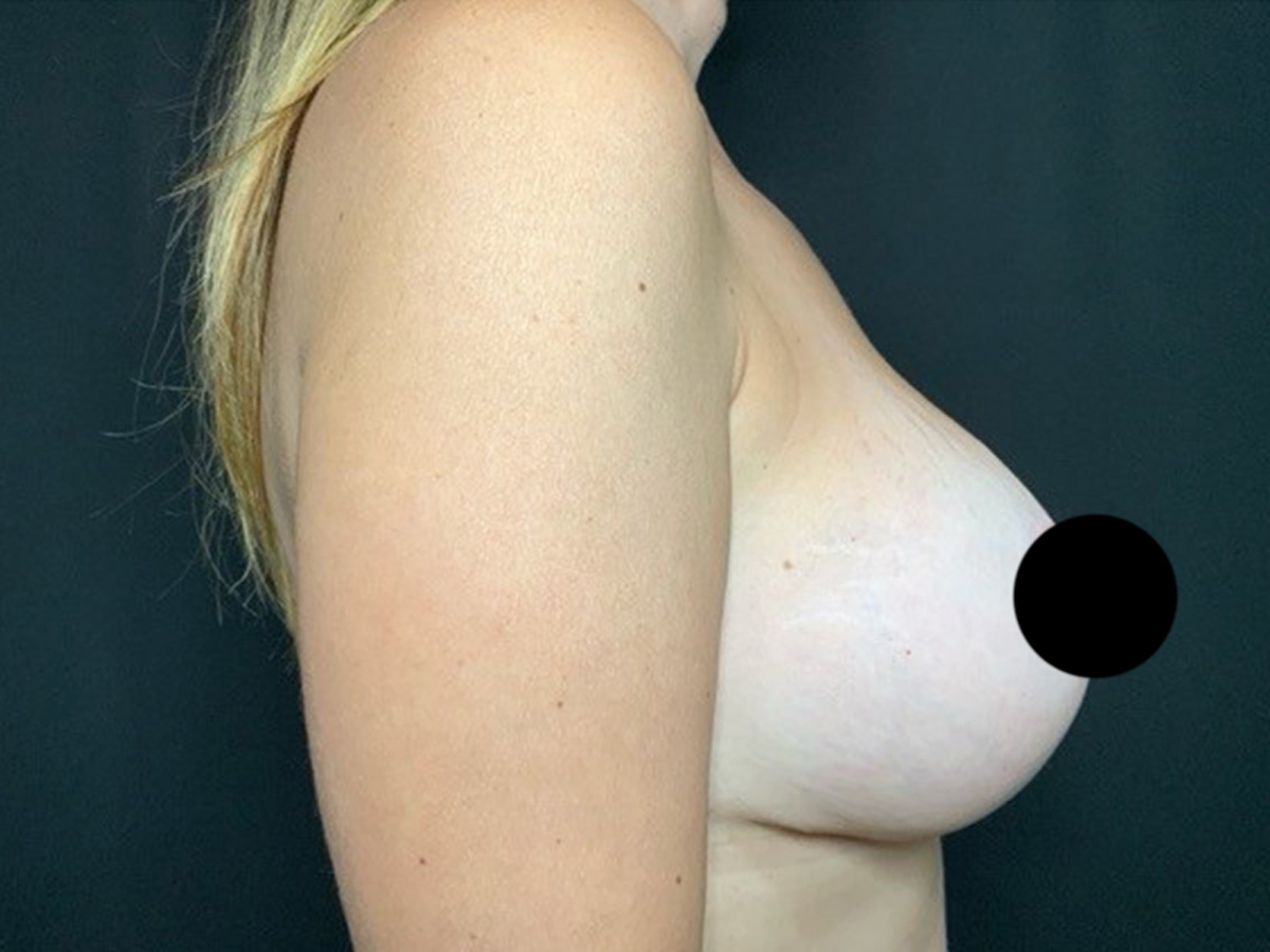 Case--7985 | After Breast Revision 2