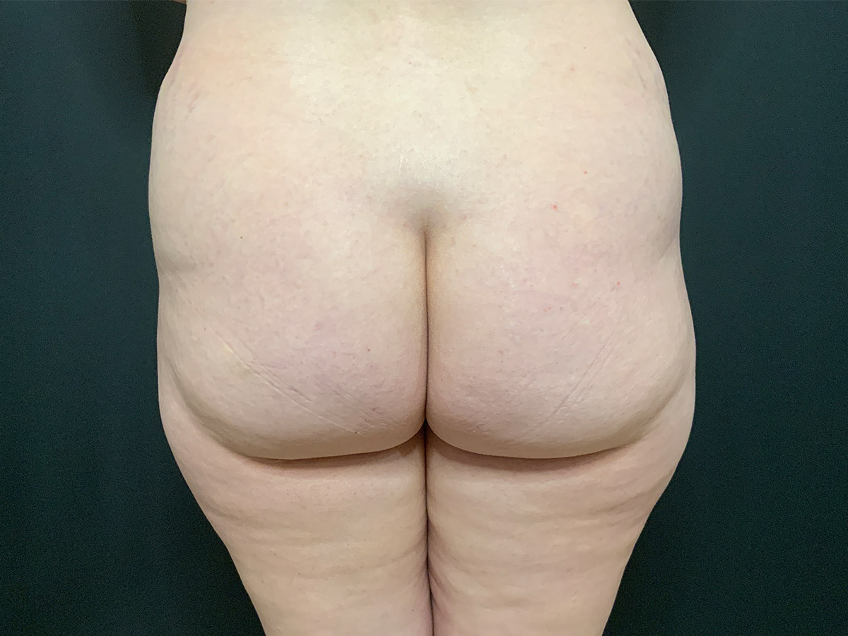 Case--2165 | Before Body