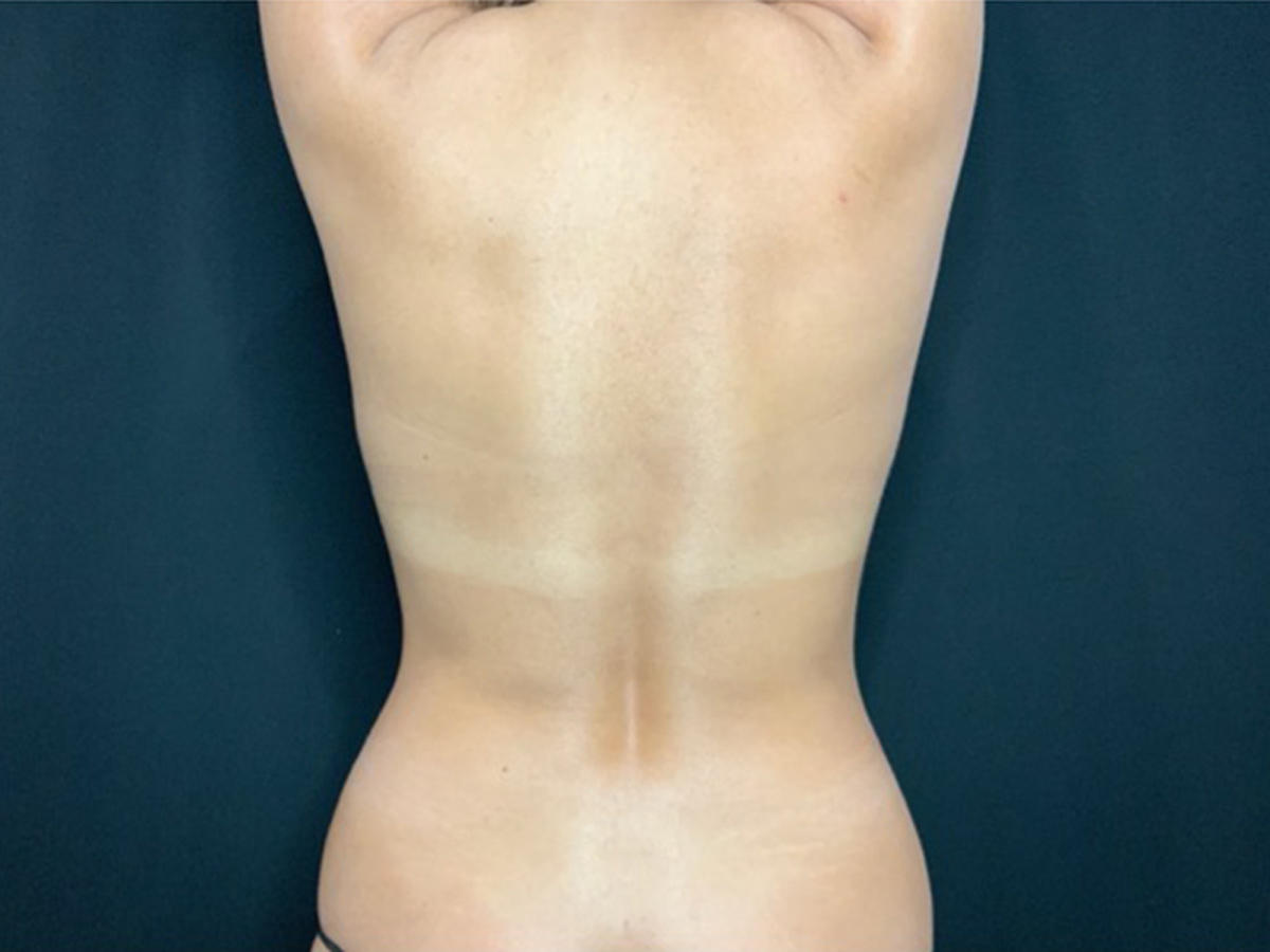 Case--8148 | Before Liposuction 2