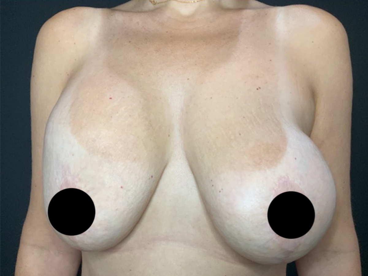 Case--7985 | Before Breast