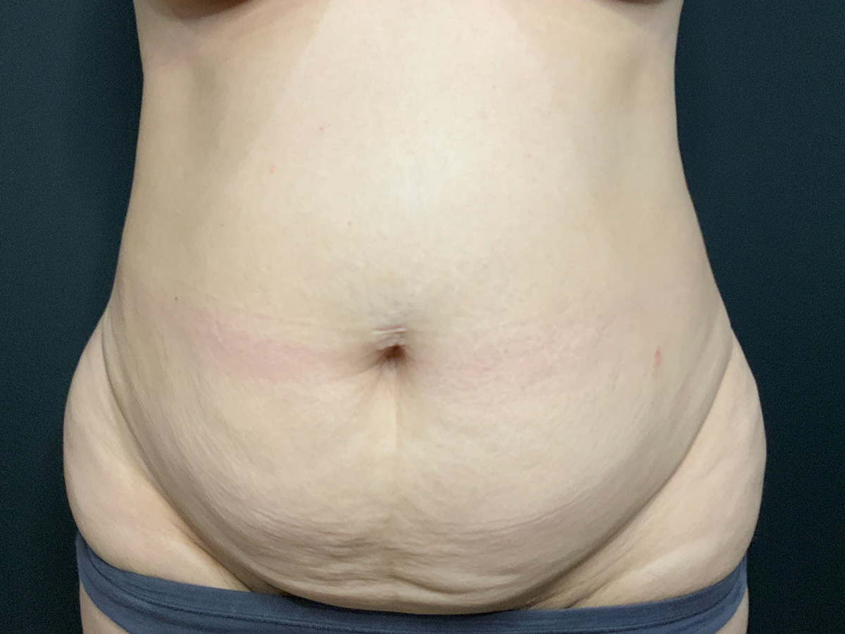 Case--8578 | Before Tummy Tuck