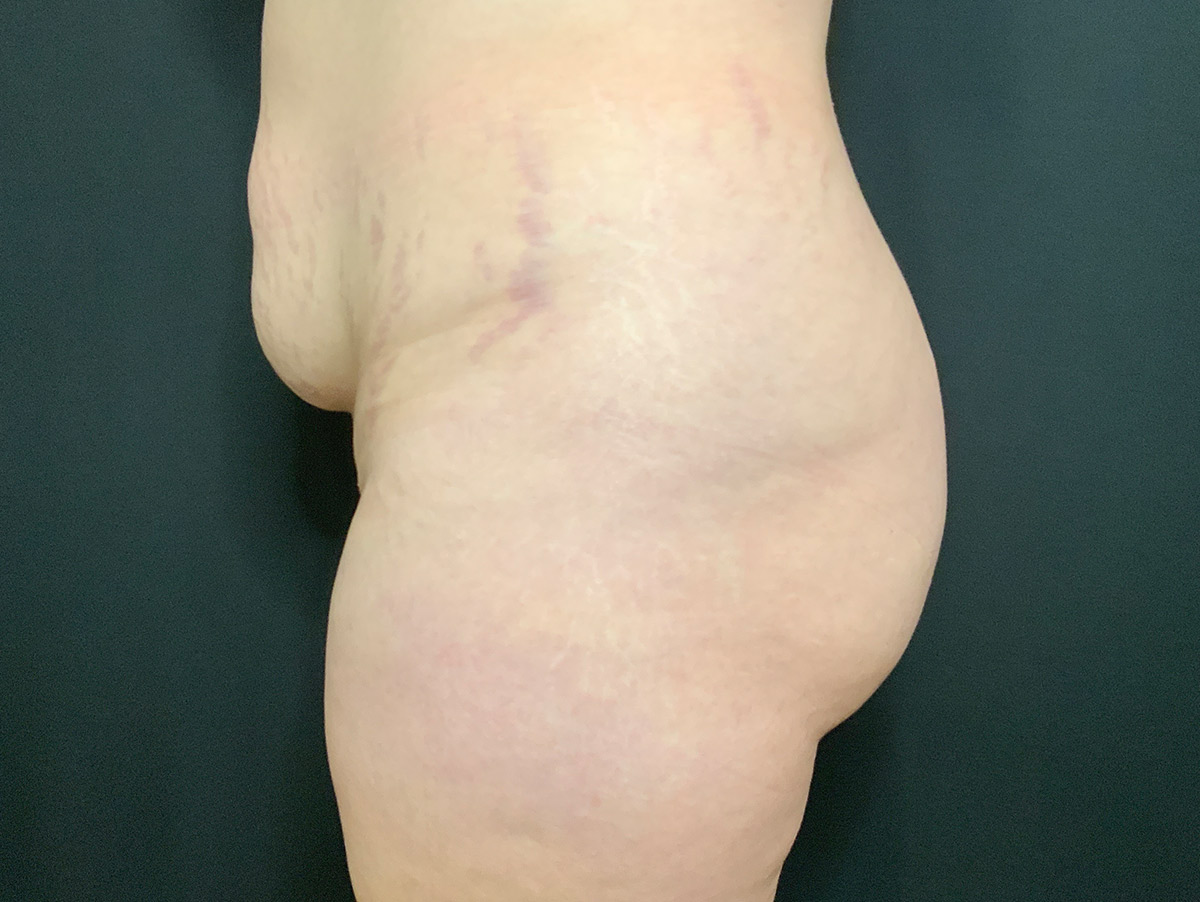 Case--2165 | Before Brazilian Butt Lift 2