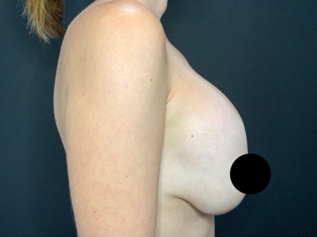 Case--7985 | Before Breast Revision 2