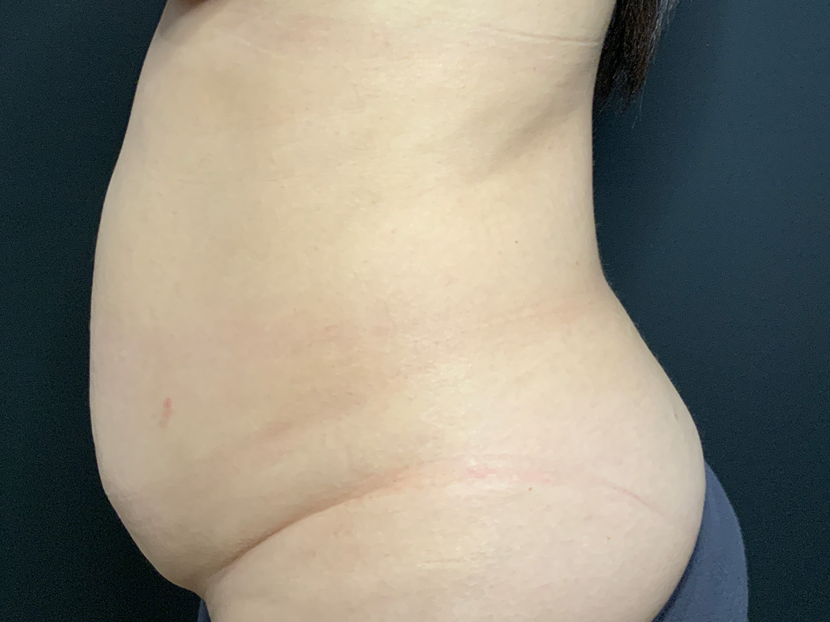 Case--8578 | Before Tummy Tuck 2