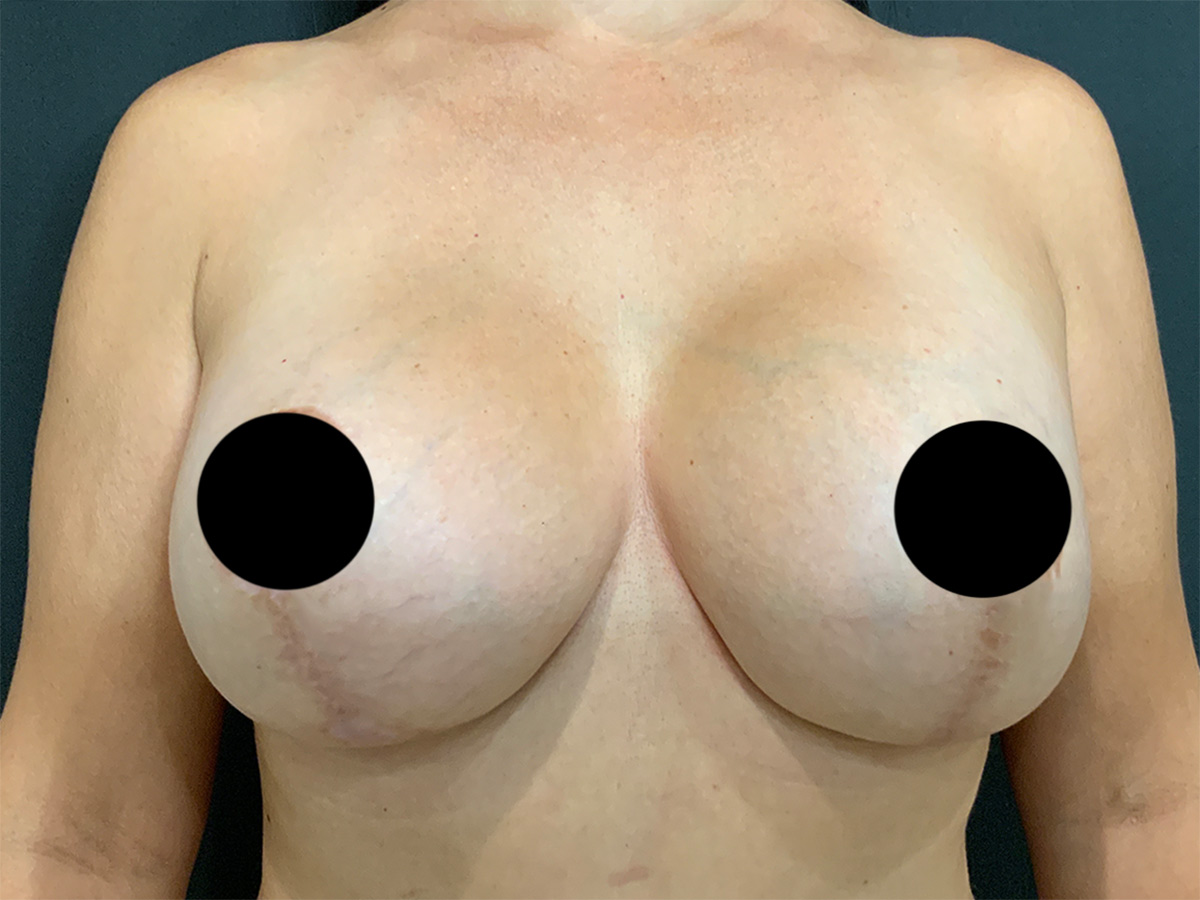 Case--1911 | After Breast Augmentation + Lift