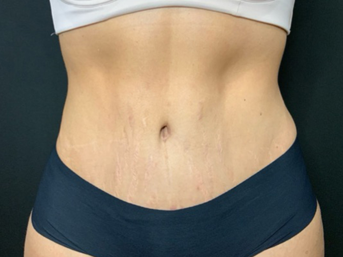 Case--8991 | After Tummy Tuck