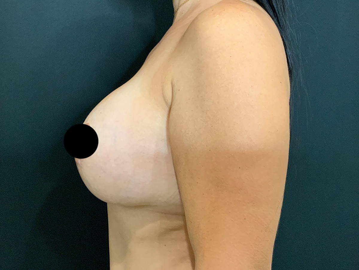 Case--1911 | After Breast Augmentation + Lift 2
