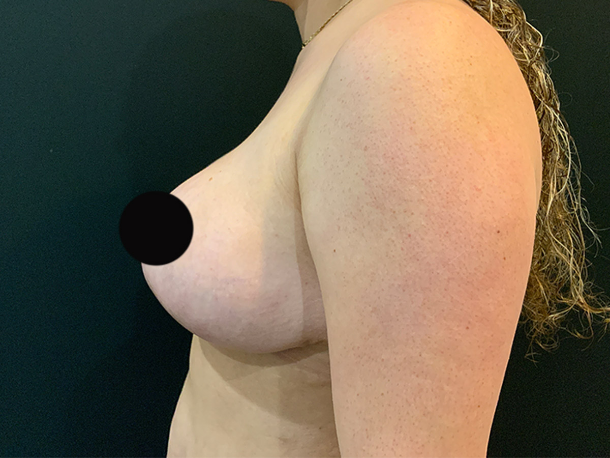 Case--6555 | After Breast Reduction 2