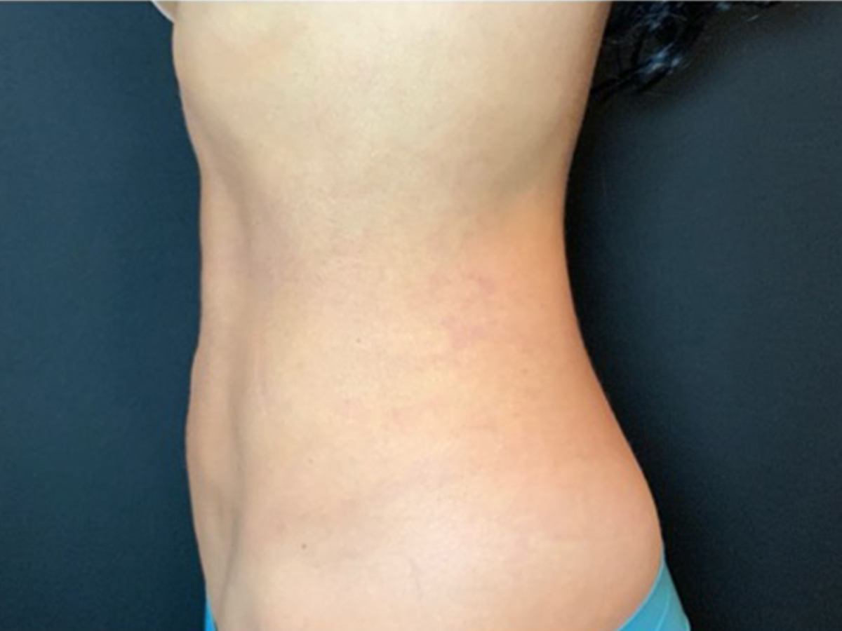 Case--5003 | After Liposuction 2