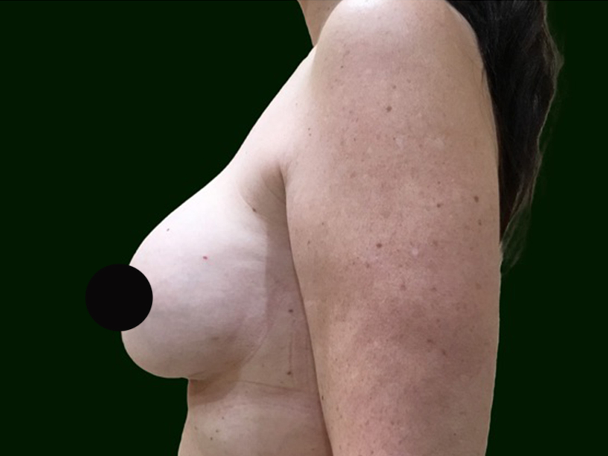 Case--7498 | After Breast Revision 2