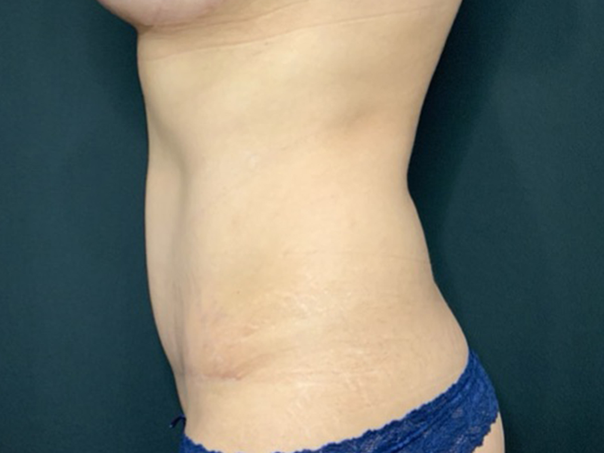 Case--5732 | After Mommy Makeover 4