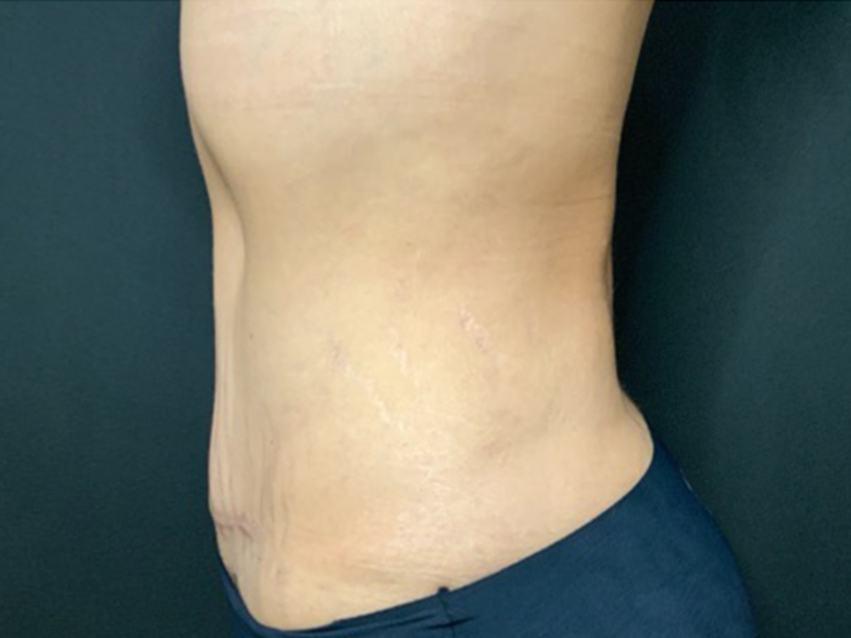 Case--8991 | After Tummy Tuck 2