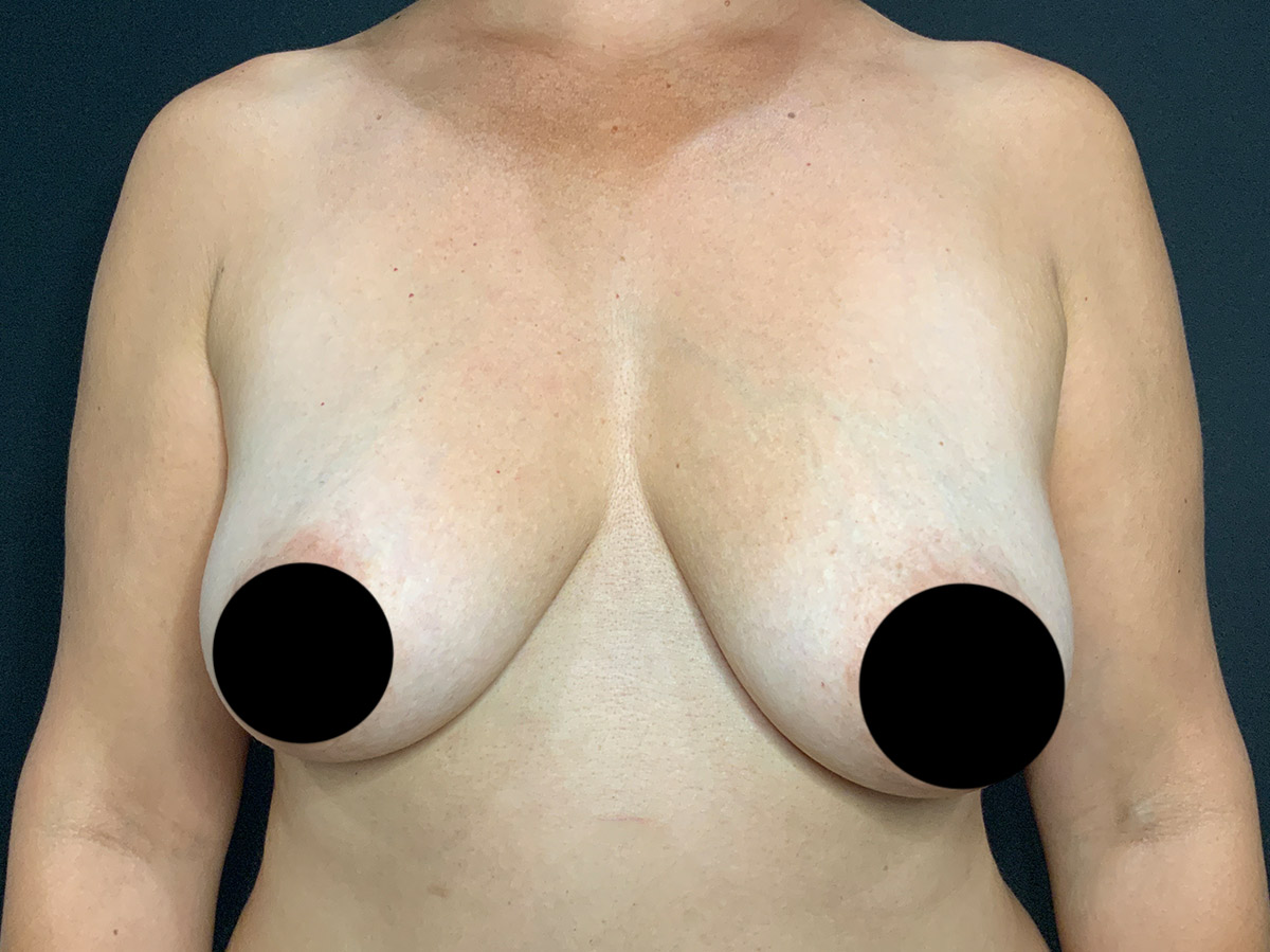 Case--1911 | Before Breast Augmentation + Lift