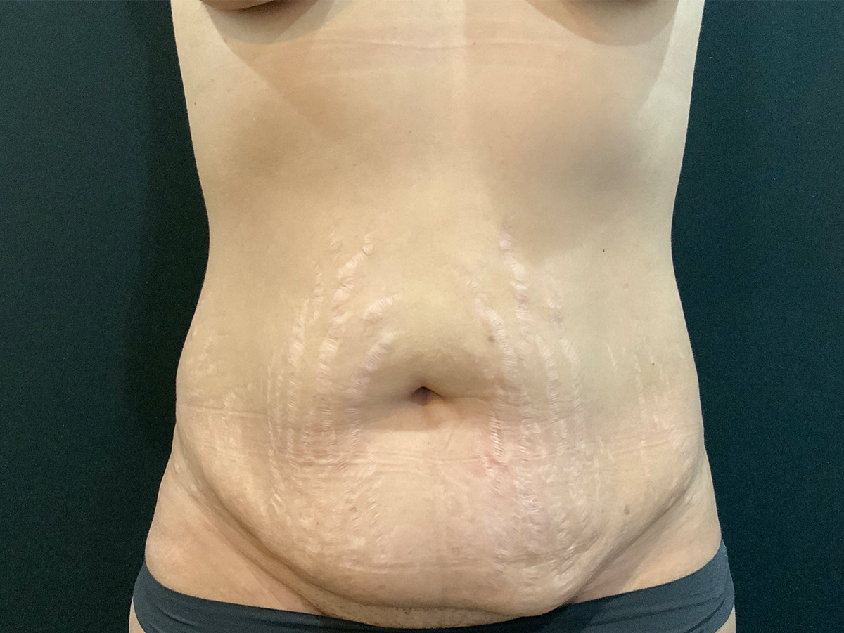 Case--8991 | Before Tummy Tuck
