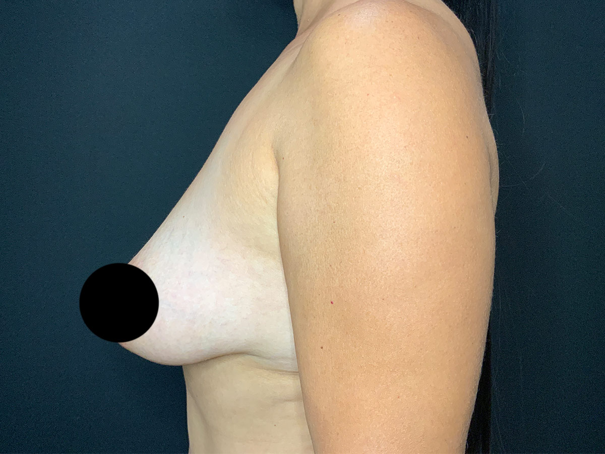 Case--1911 | Before Breast Augmentation + Lift 2