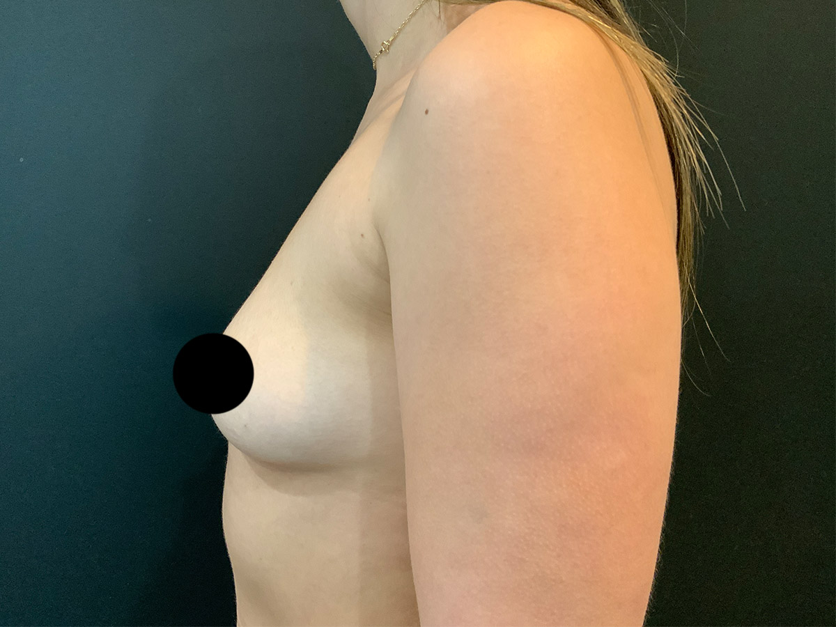 Case--3739 | Before Breast Augmentation 2