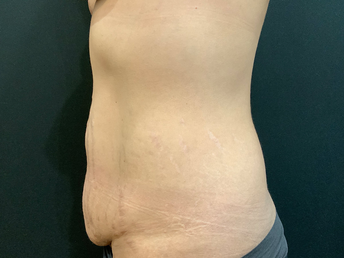 Case--8991 | Before Tummy Tuck 2