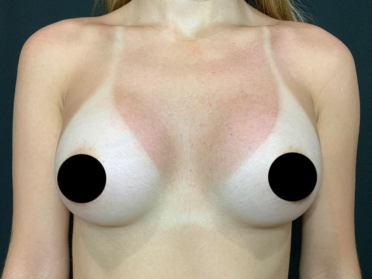 Case--1134 | After Breast Augmentation