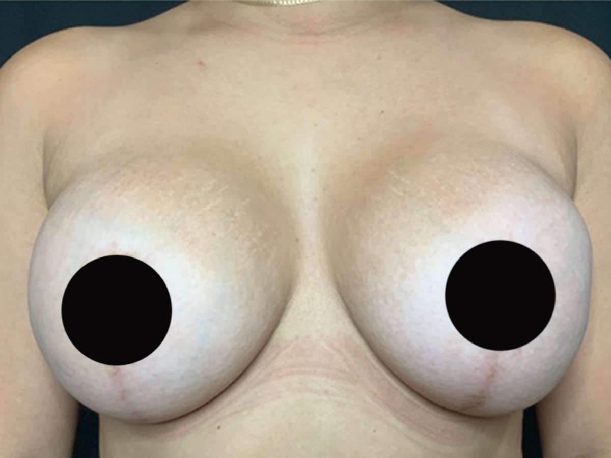 Case--7810 | After Breast