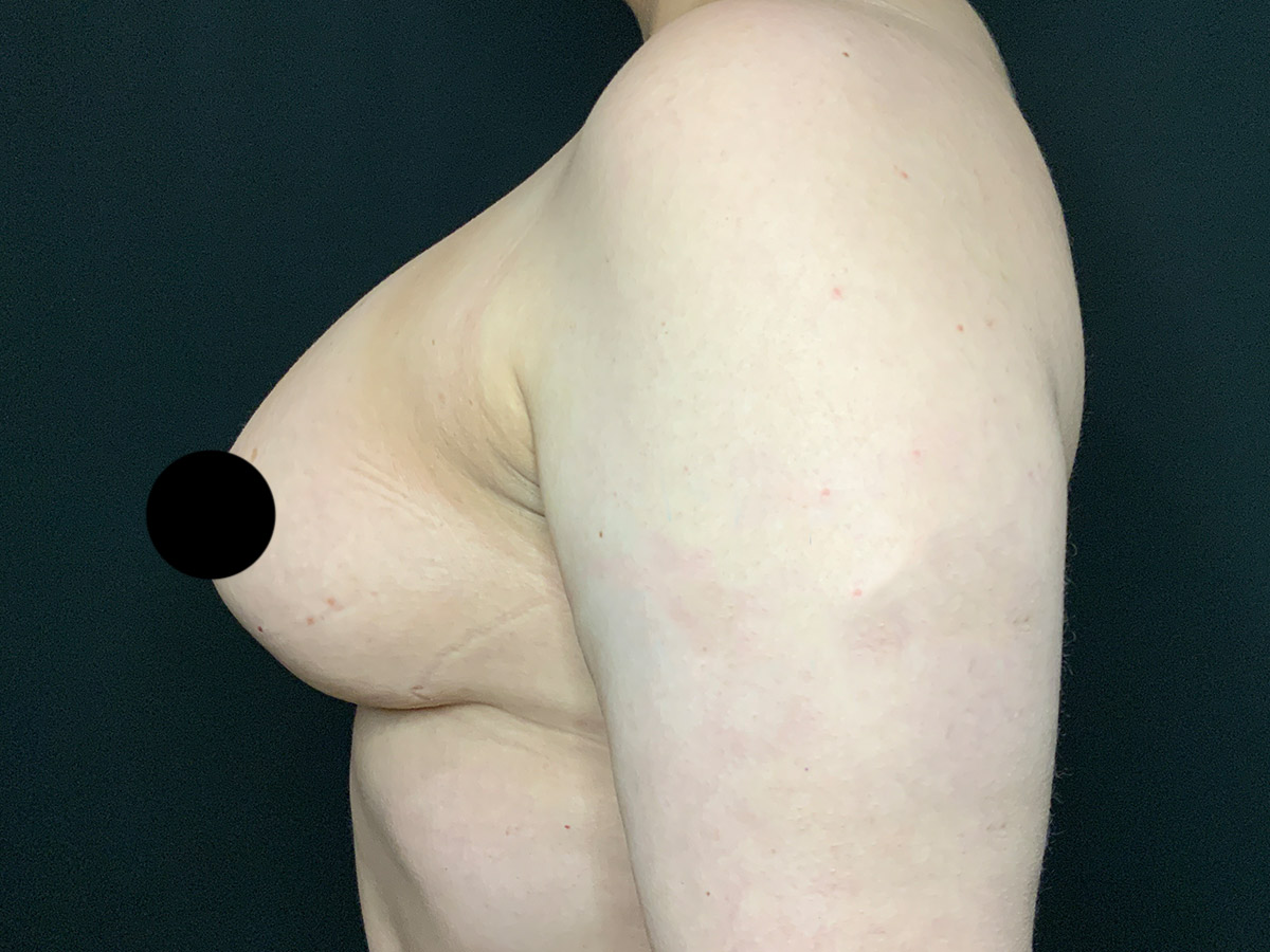 Case--2336 | After Breast Augmentation + Lift 2