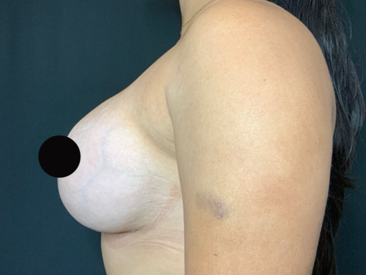 Case--7810 | After Breast Revision 2