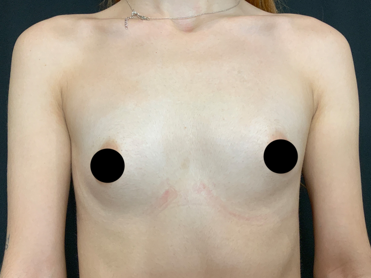 Case--1134 | Before Breast Augmentation