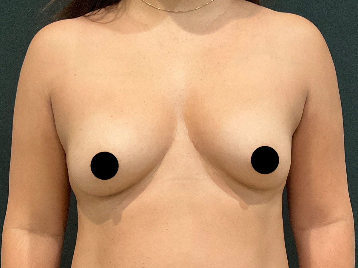 Case--7504 | Before Mommy Makeover