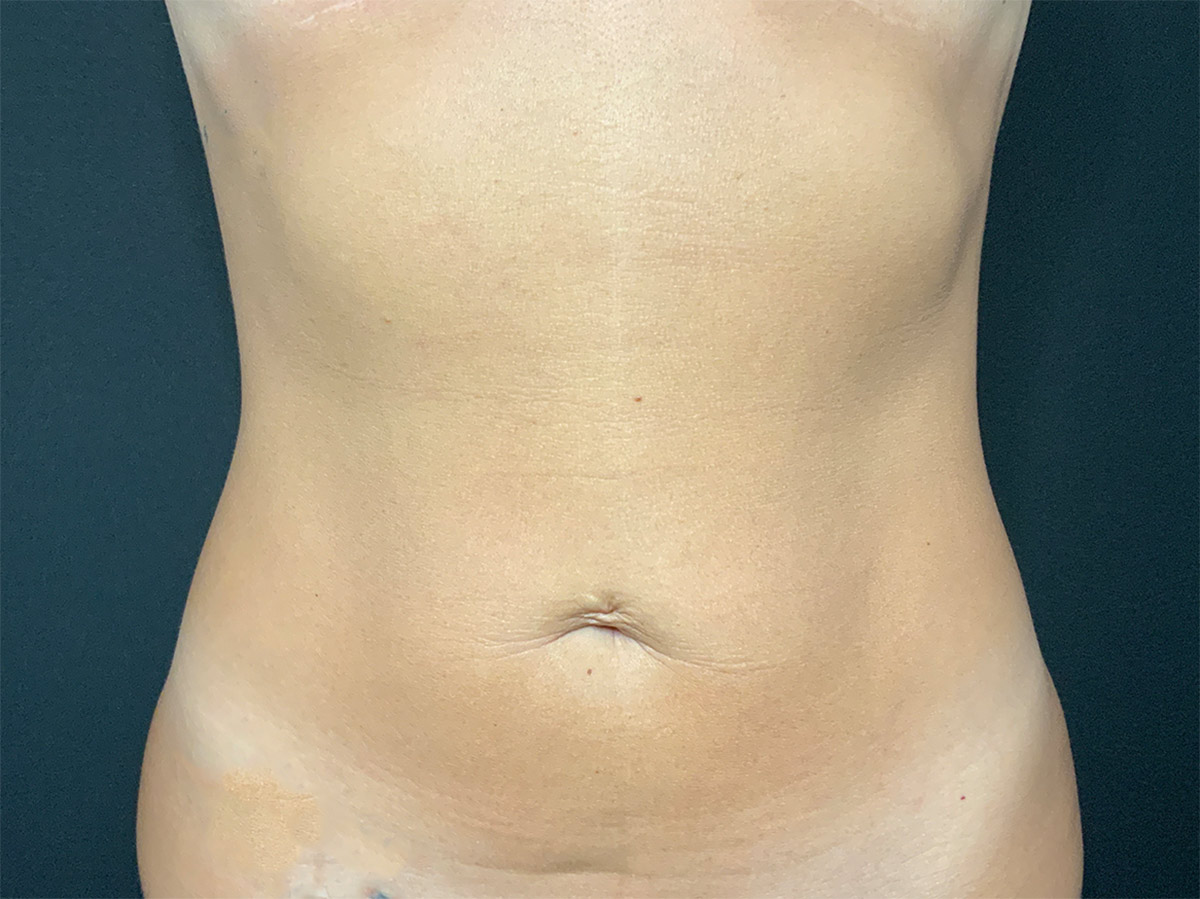 Case--9252 | Before Body