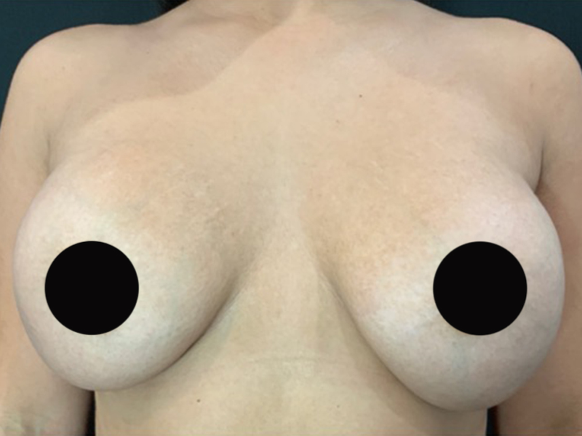 Case--7810 | Before Breast