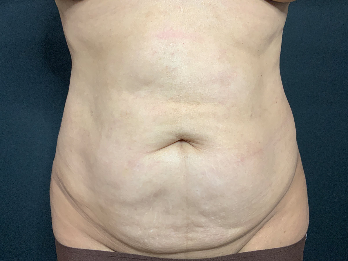 Case--2163 | Before Tummy Tuck