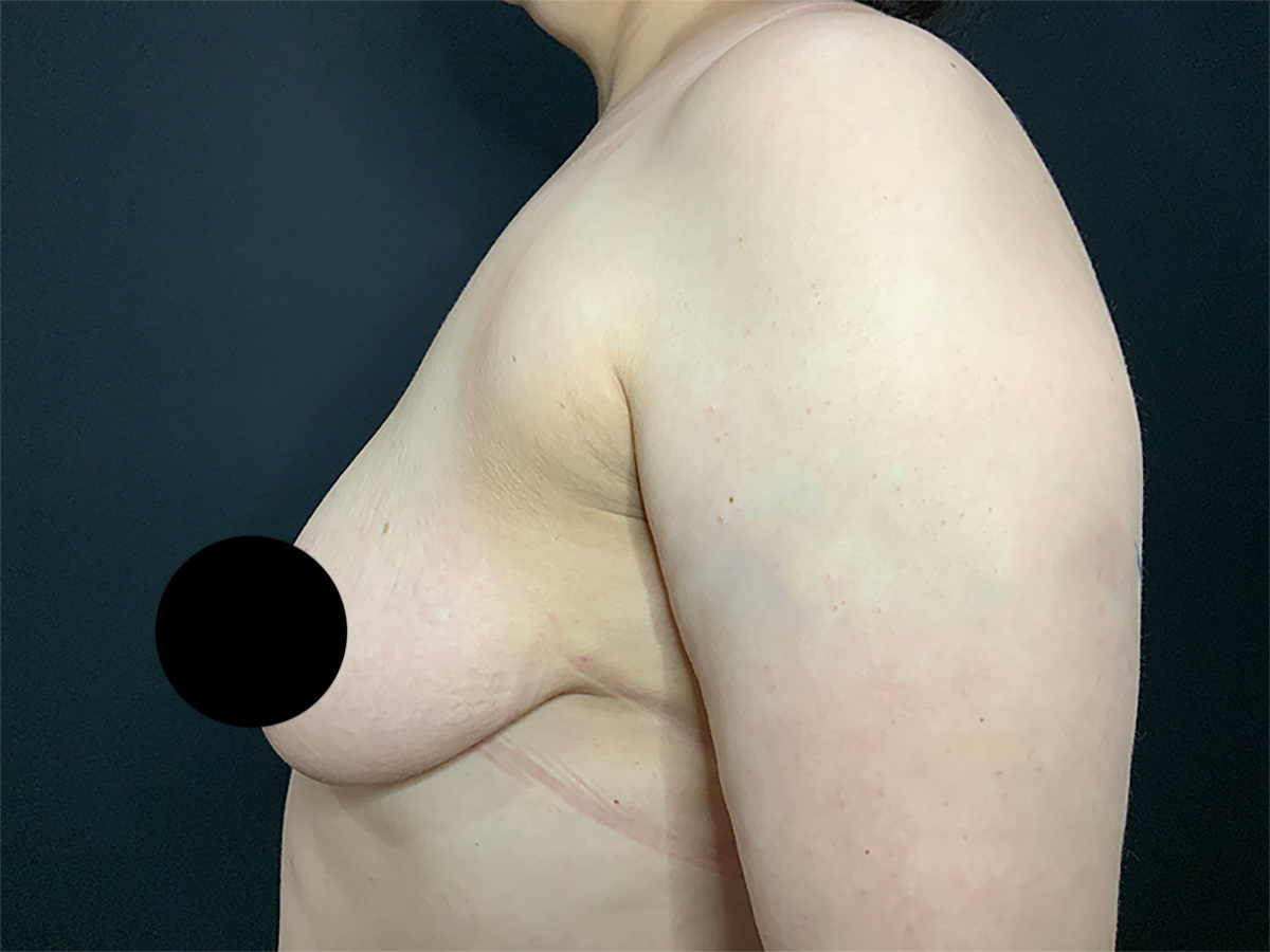 Case--2336 | Before Breast Augmentation + Lift 2