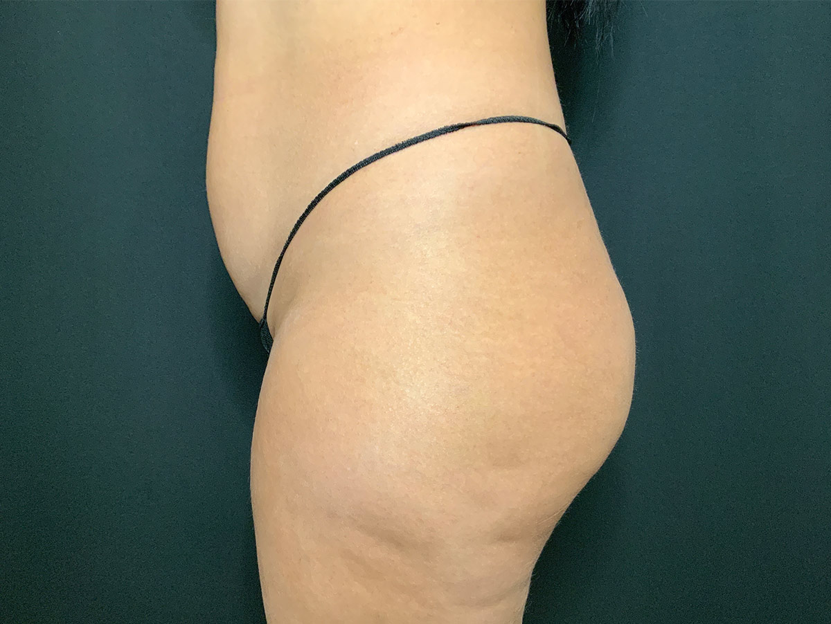 Case--2487 | Before Brazilian Butt Lift 2