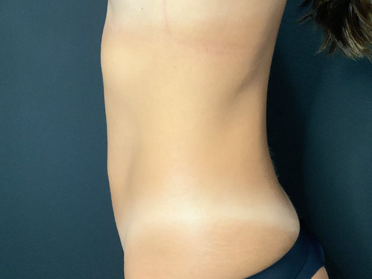 Case--9252 | Before Liposuction 2