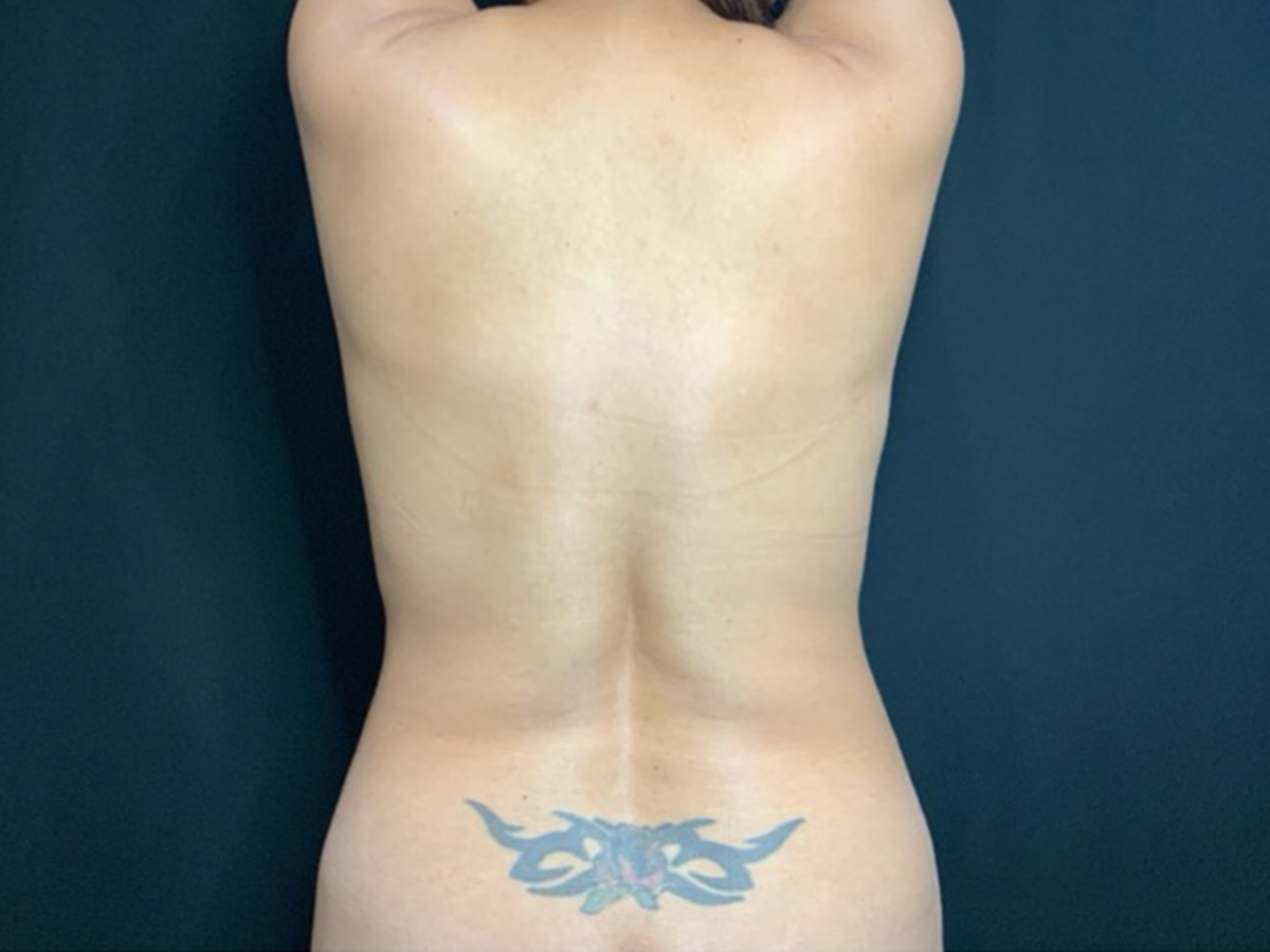 Case--4086 | Before Liposuction 2