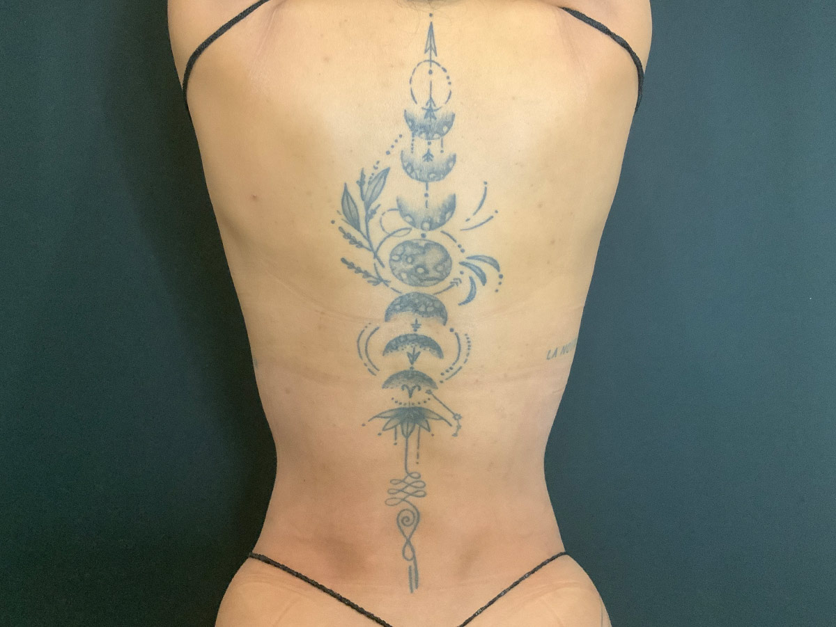 Case--6587 | After Liposuction 2